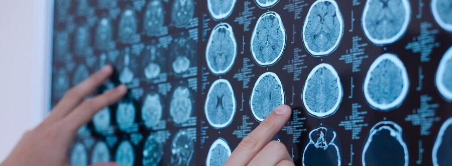 Accure Therapeutics recluta al primer paciente para el ensayo clínico en fase II de su tratamiento para la neuritis óptica aguda