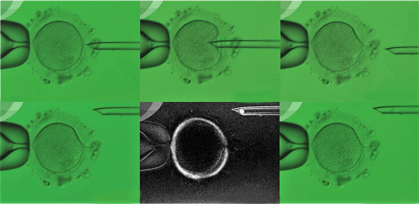 The world's first clinical trial of Maternal Spindle Transfer shows its